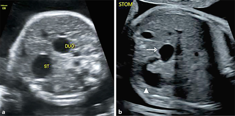 Prenatal ultrasound images showing the double bubble sign in duodenal atresia with dilated stomach and proximal duodenum