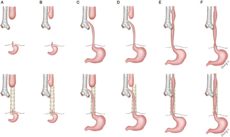 Gross classification of esophageal atresia and tracheoesophageal fistula types A through E
