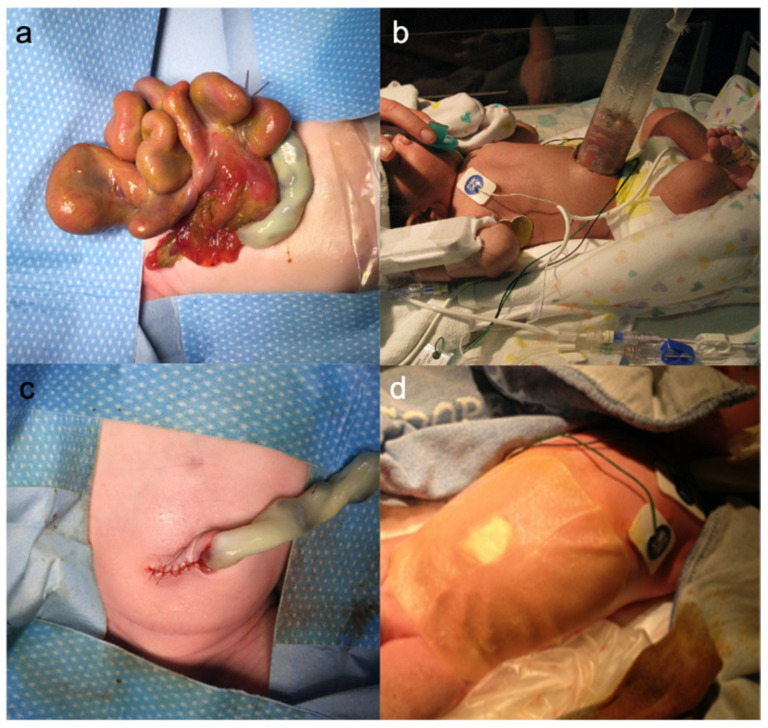 Illustration showing gastroschisis management including herniated bowel, silo treatment, and closure techniques