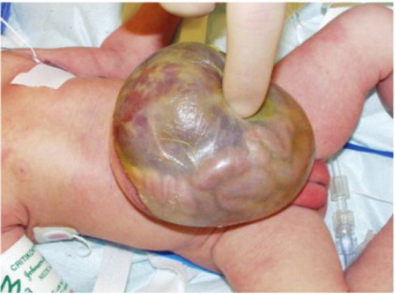 Clinical photograph of a giant omphalocele containing bowel and liver covered by a membranous sac