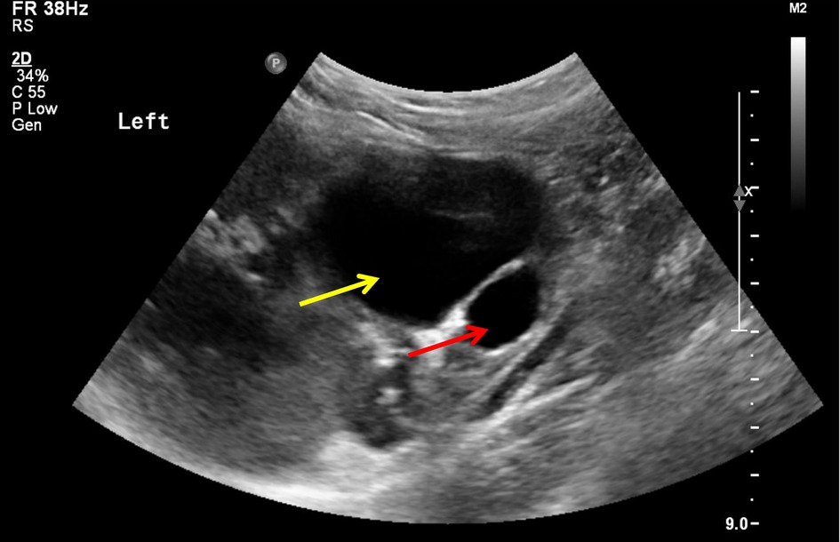 Classification diagram of hypospadias types showing glanular, coronal, midshaft, and penoscrotal meatal positions