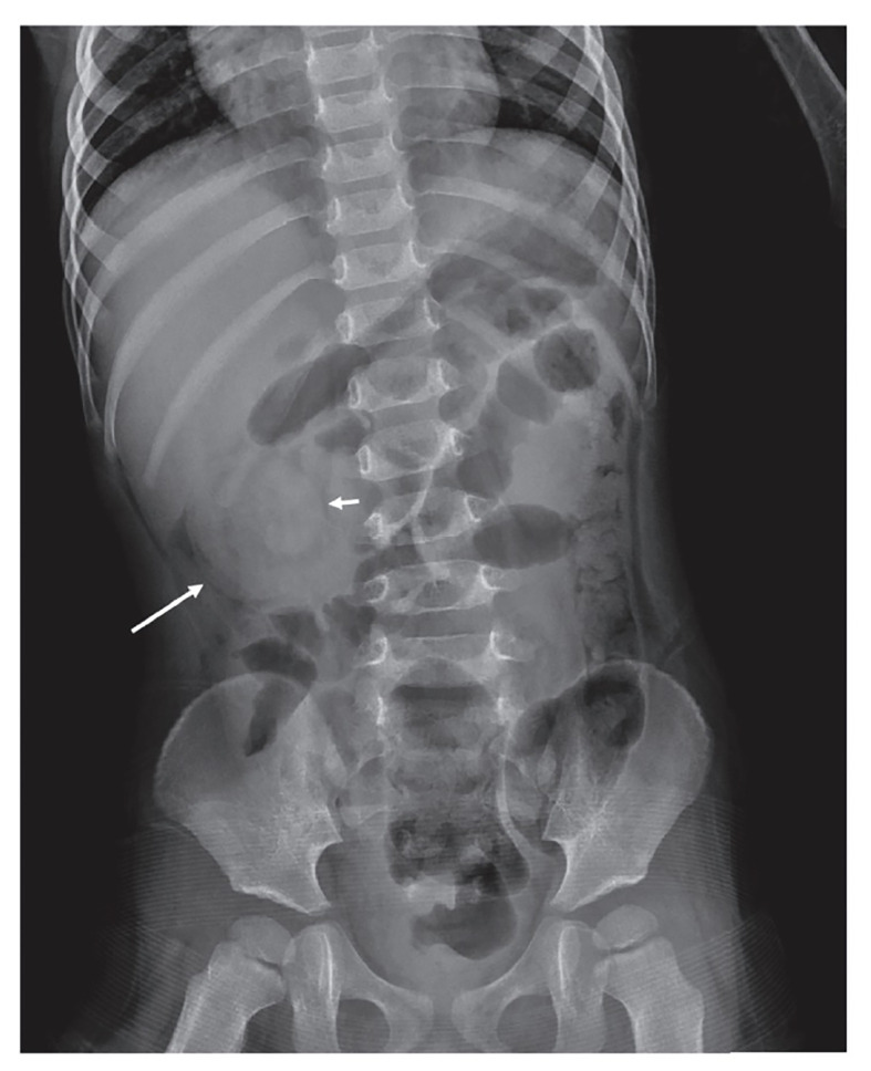 Abdominal radiograph showing soft tissue mass and radiolucent ring in malrotation and volvulus imaging