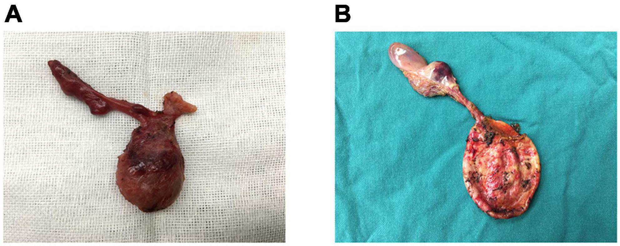 Ultrasound imaging of pediatric appendicitis showing inflamed noncompressible appendix with periappendiceal fluid
