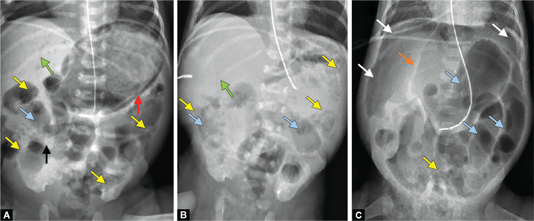 Sequential abdominal radiographs showing pneumatosis intestinalis, portal venous gas, and pneumoperitoneum in NEC