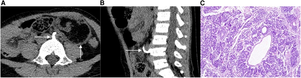 CT scan of pediatric abdominal neuroblastoma showing large heterogeneous retroperitoneal mass crossing the midline with calcifications