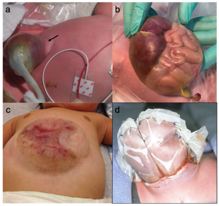 Illustration of omphalocele variants and treatment including hernia into cord, giant omphalocele, and staged closure