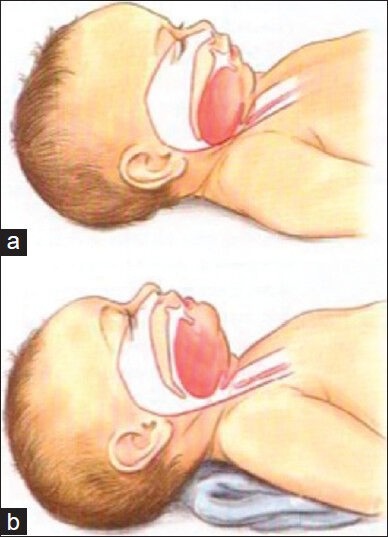 Pediatric airway positioning for intubation showing anatomical differences in the neonatal airway