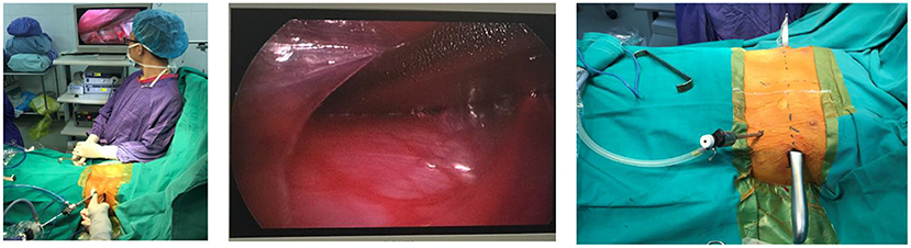 Intraoperative thoracoscopic view during pediatric minimally invasive surgery demonstrating port placement and working space