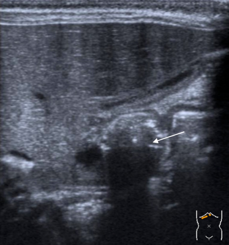 Ultrasound measurements of pyloric stenosis showing muscle thickness and channel length criteria