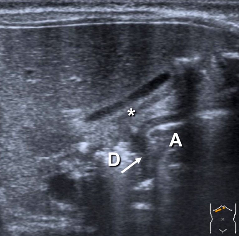 Ultrasound image of hypertrophic pyloric stenosis showing thickened pyloric muscle and elongated pyloric channel