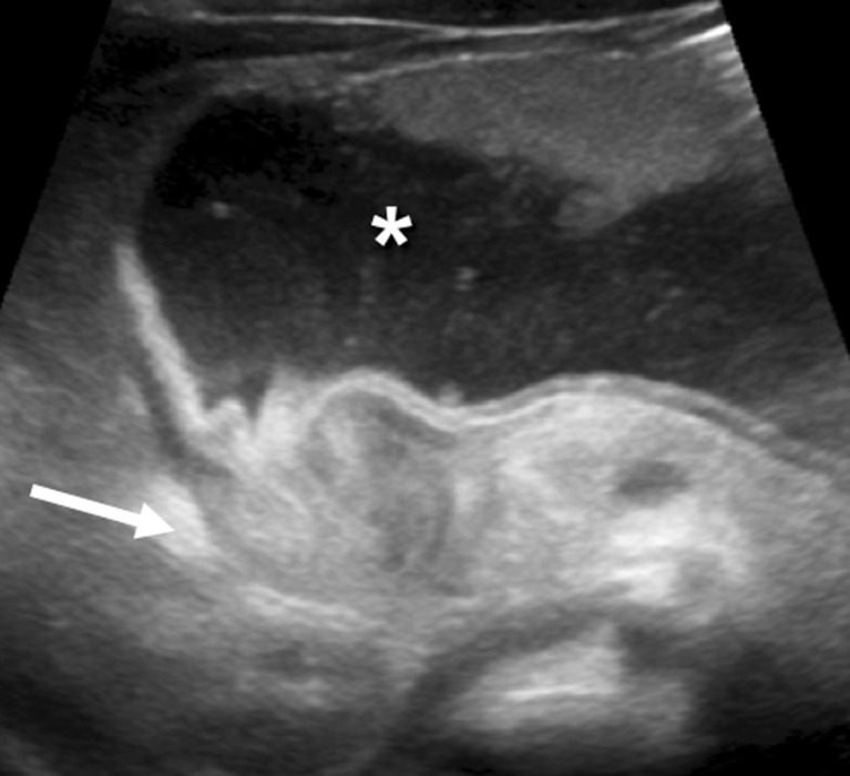 Transverse ultrasound view of hypertrophic pyloric stenosis showing the target sign with thickened muscle ring