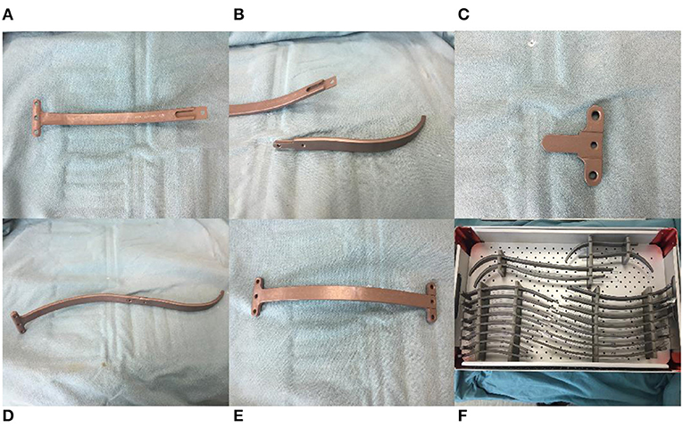 Modified Nuss procedure images showing pectus bar insertion and correction of chest wall deformity