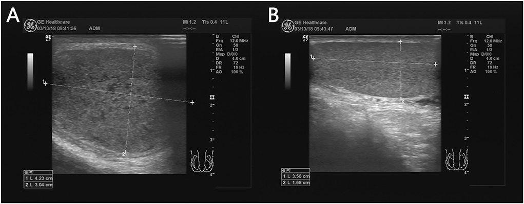Color Doppler ultrasound of testicular torsion showing absent blood flow in the affected testis compared to normal contralateral side