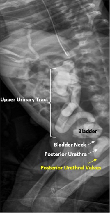 Voiding cystourethrogram demonstrating posterior urethral valves with dilated posterior urethra and trabeculated bladder