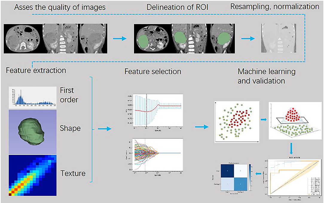 CT imaging of Wilms tumor showing large intrarenal mass with enhancement pattern and staging characteristics