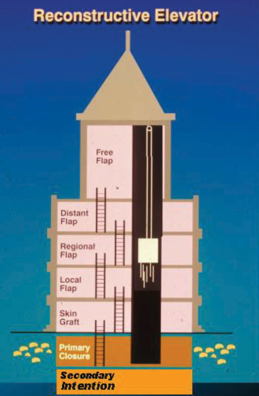 Diagram of the reconstructive elevator concept showing direct access to any level of reconstruction based on defect requirements