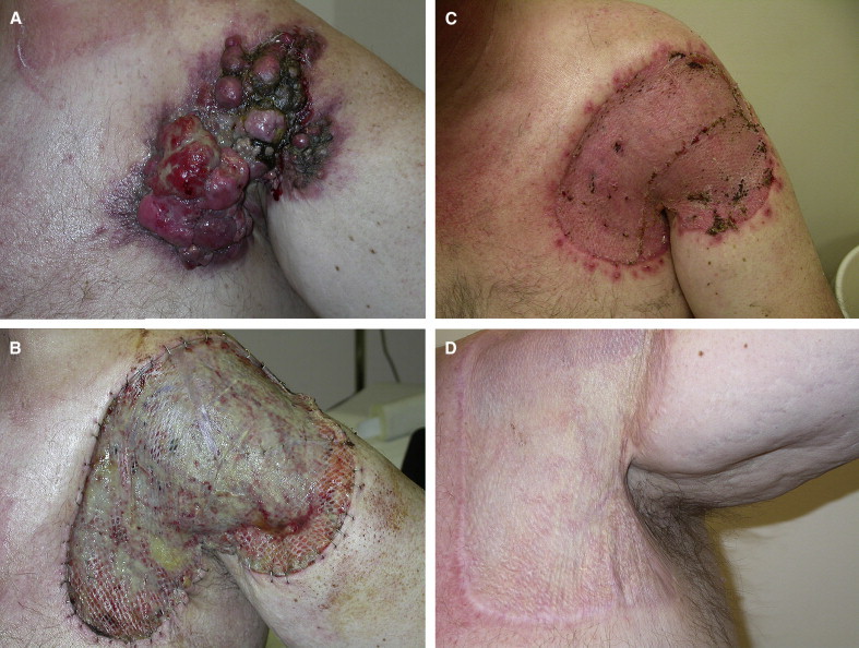 Clinical photograph and diagram showing split-thickness skin graft harvest technique and wound coverage