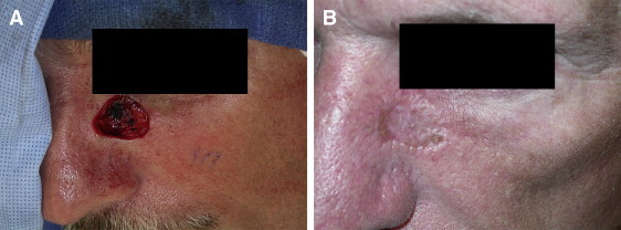 Clinical image showing full-thickness skin graft harvest and application with primary donor site closure
