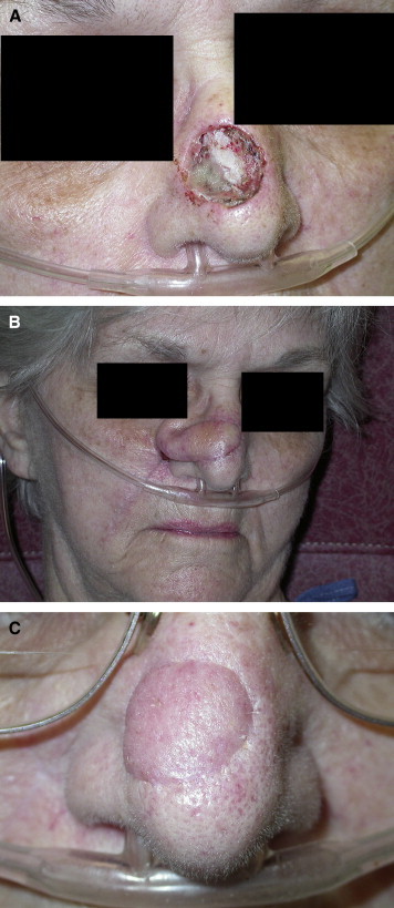 Clinical photograph showing a regional pedicled muscle flap used for reconstructive surgery