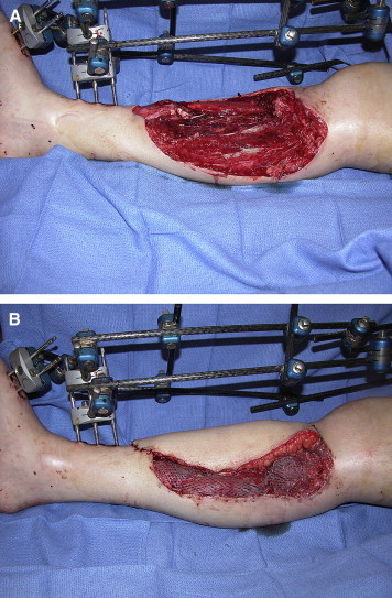 Clinical photograph showing free tissue transfer with microvascular anastomosis for complex wound reconstruction