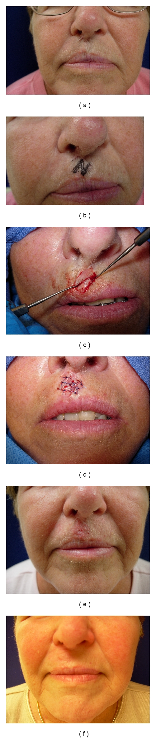 Diagram showing Z-plasty design, execution, and result with triangular flaps transposing to lengthen a contracted scar