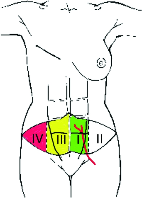 Diagram of DIEP flap showing Hartrampf zones I-IV of the lower abdominal skin paddle and deep inferior epigastric perforator anatomy