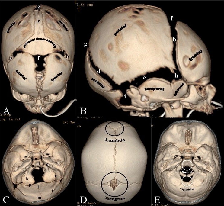 3D CT reconstructions showing different craniosynostosis types including scaphocephaly, trigonocephaly, and plagiocephaly with fused suture patterns