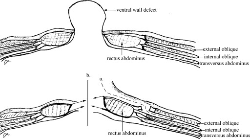 Anatomical diagram of component separation technique showing external oblique release and rectus advancement for abdominal wall reconstruction