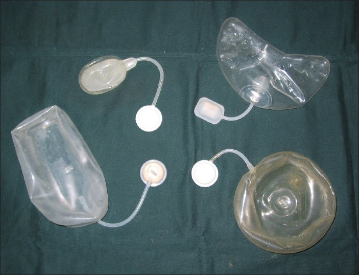 Clinical photograph and diagram showing tissue expansion technique with silicone expander placed subcutaneously and serial inflation over weeks