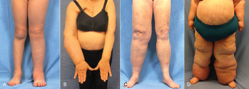 Clinical photographs and diagram showing ISL staging of lymphedema from Stage 0 subclinical to Stage III elephantiasis
