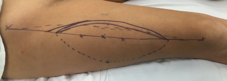 Intraoperative image showing ALT flap perforator marking with Doppler on the thigh between ASIS and patella midpoint