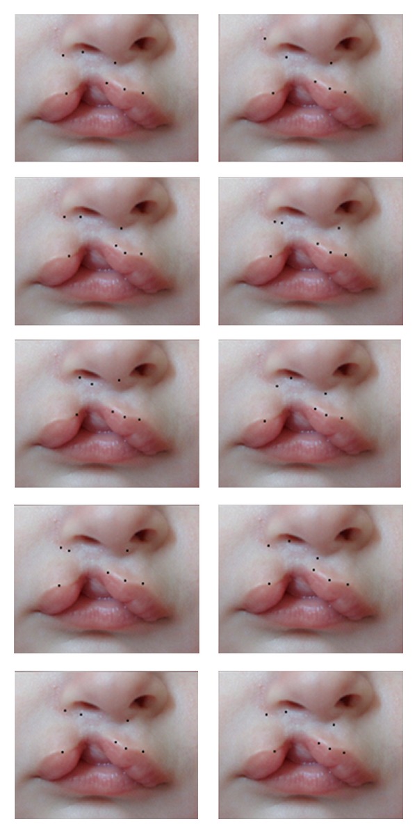Surgical technique showing Millard rotation-advancement method for unilateral cleft lip repair with anatomical markings