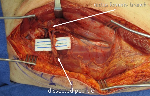 Intraoperative image showing septocutaneous perforator dissection for ALT free flap harvest with pedicle exposure