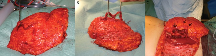 Surgical planning and technique for DIEP flap breast reconstruction showing perforator mapping and flap inset