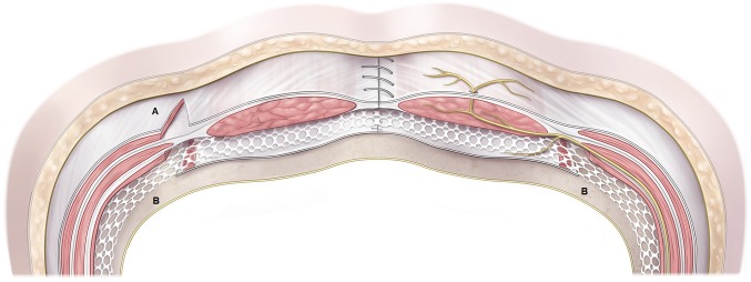Schematic diagram showing abdominoplasty perfusion zones and abdominal wall layers relevant to body contouring surgery