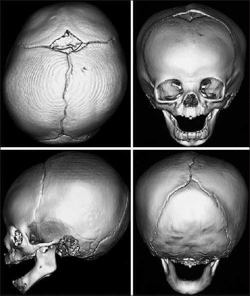Fibula free flap for mandibular reconstruction showing osteotomised bone segments and skin paddle design