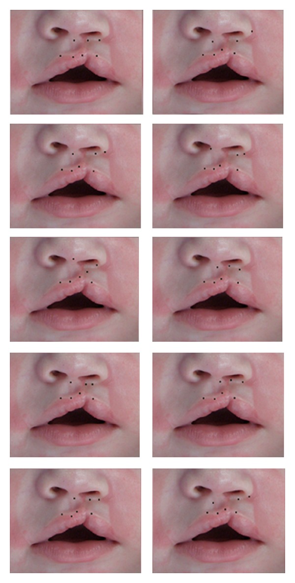 Clinical photograph showing surgical markings and technique for congenital hand anomaly repair including syndactyly release