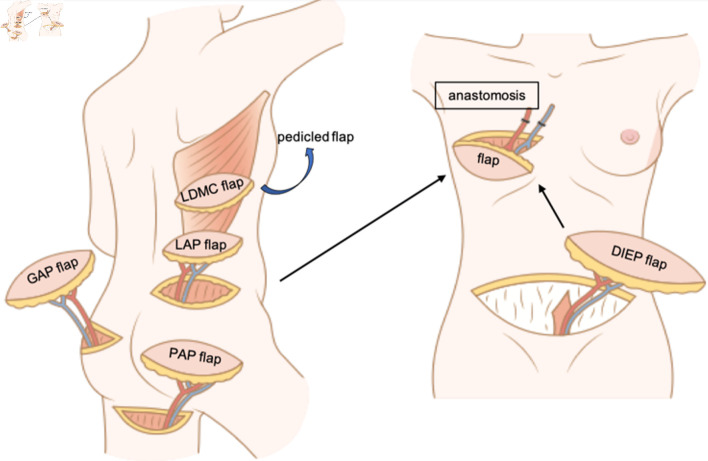 Diagram showing autologous tissue flap options for breast reconstruction including DIEP, TRAM, and latissimus dorsi flaps