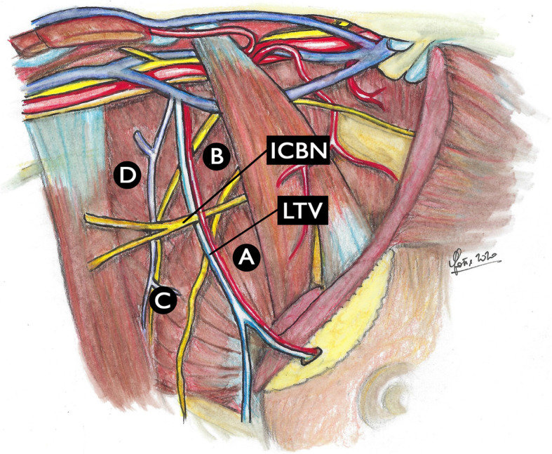 Diagram showing alternative classification systems for axillary lymph node dissection with anatomical landmarks for breast cancer surgery