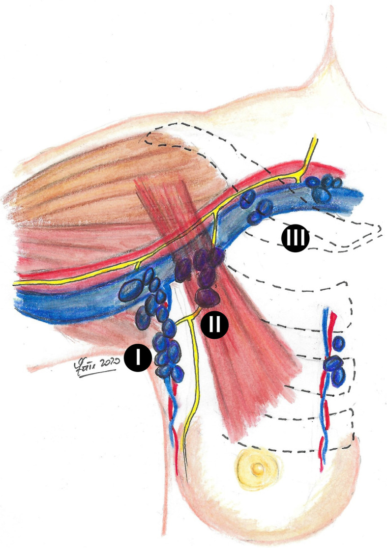 Anatomical diagram showing the three levels of axillary lymph nodes in relation to the pectoralis minor muscle