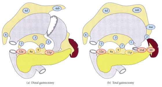 Diagram showing the extent of D1 and D2 lymphadenectomy in gastric cancer surgery with color-coded lymph node groups