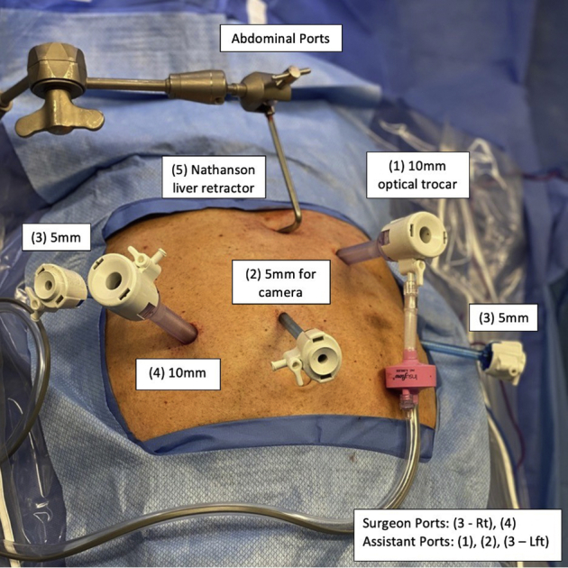 Diagram showing trocar placement for minimally invasive Ivor Lewis esophagectomy during the abdominal phase