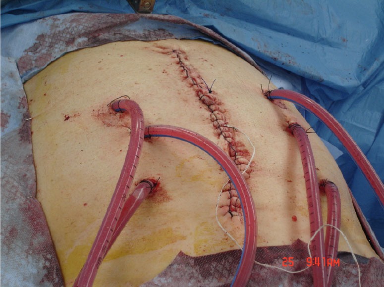 Photograph showing the closed technique for HIPEC with chemotherapy circulating through inflow and outflow catheters