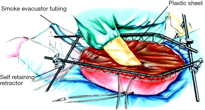 Photograph showing the open Coliseum technique for HIPEC with the abdomen held open and chemotherapy solution circulating