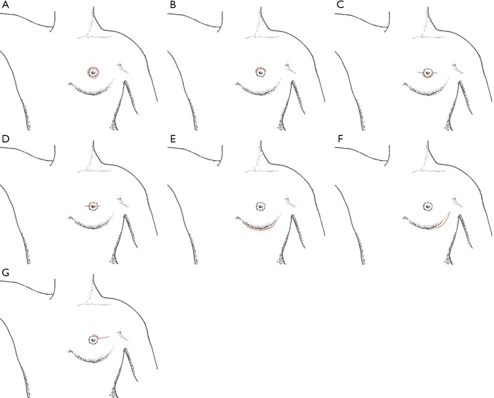 Diagram showing different incision patterns for nipple-sparing mastectomy including inframammary, lateral radial, and periareolar approaches