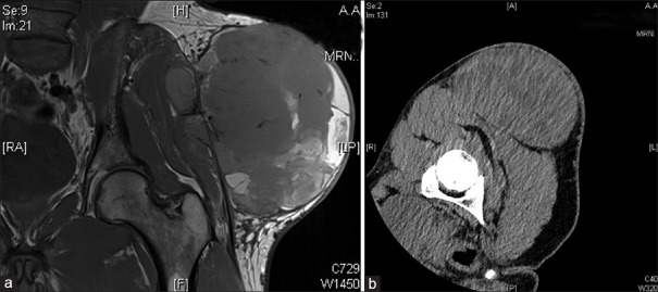MRI imaging showing soft tissue tumor depth assessment for surgical planning