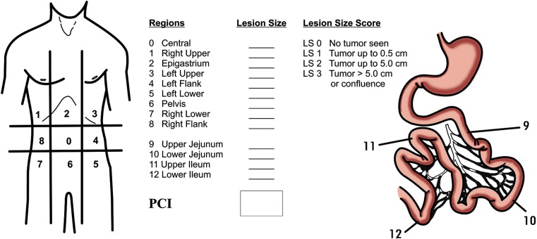 Diagram showing the Peritoneal Cancer Index scoring system with 13 abdominal regions scored 0-3
