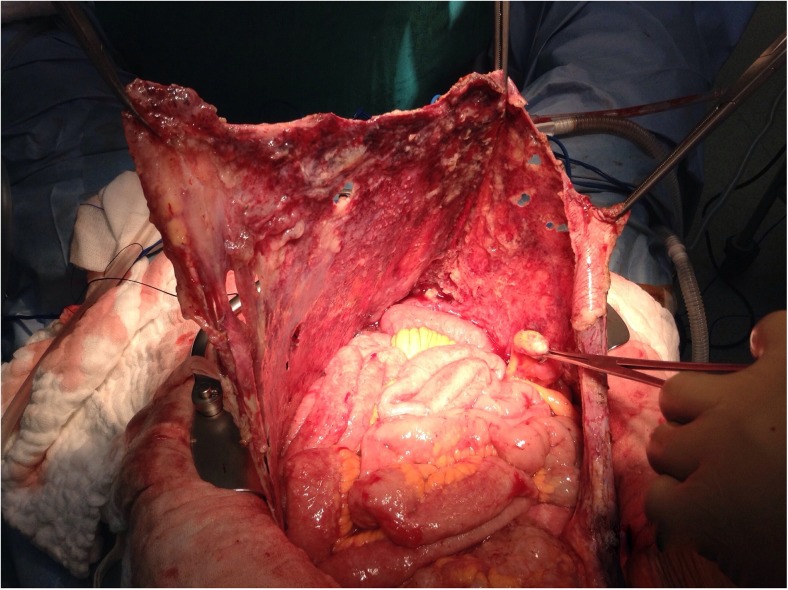 Illustration of anterolateral parietal peritonectomy technique during cytoreductive surgery