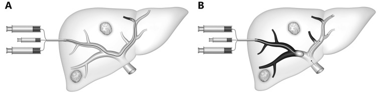 Schematic diagram showing the ipsilateral approach for portal vein embolization with transhepatic access