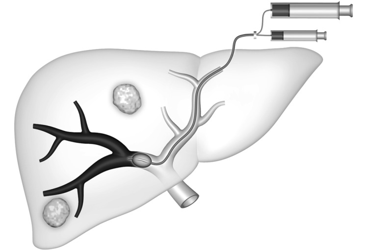 Schematic diagram showing the contralateral approach for portal vein embolization technique